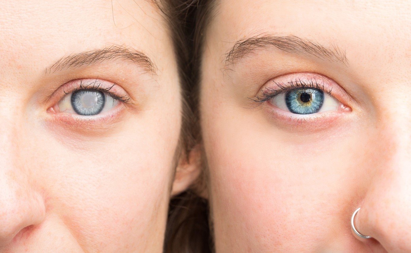 porovnanie očí zdravého človeka a pacienta so šedým zákalom