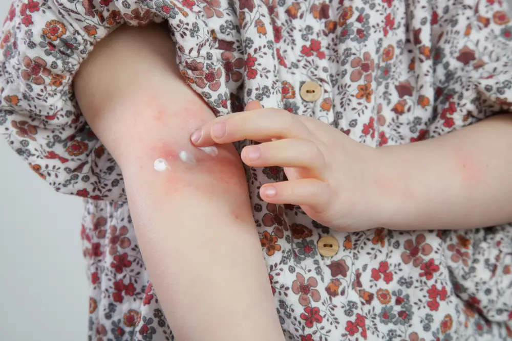 dieťa si ošetruje atopickú dermatitídu na ruke