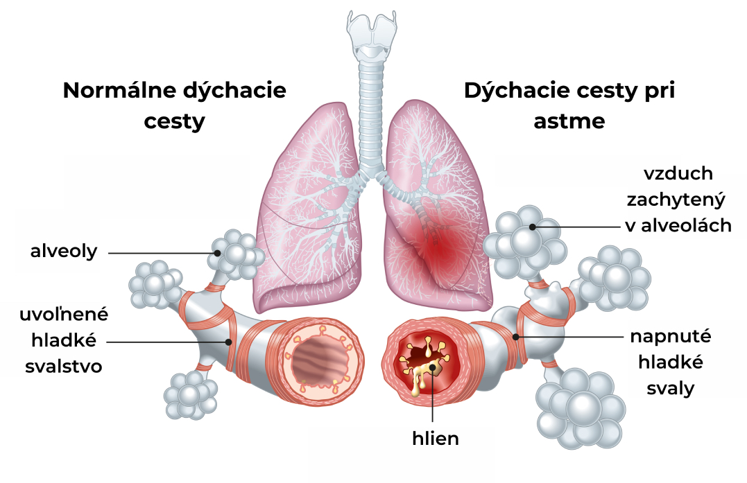anatomia pluc a popis zmien pri astme