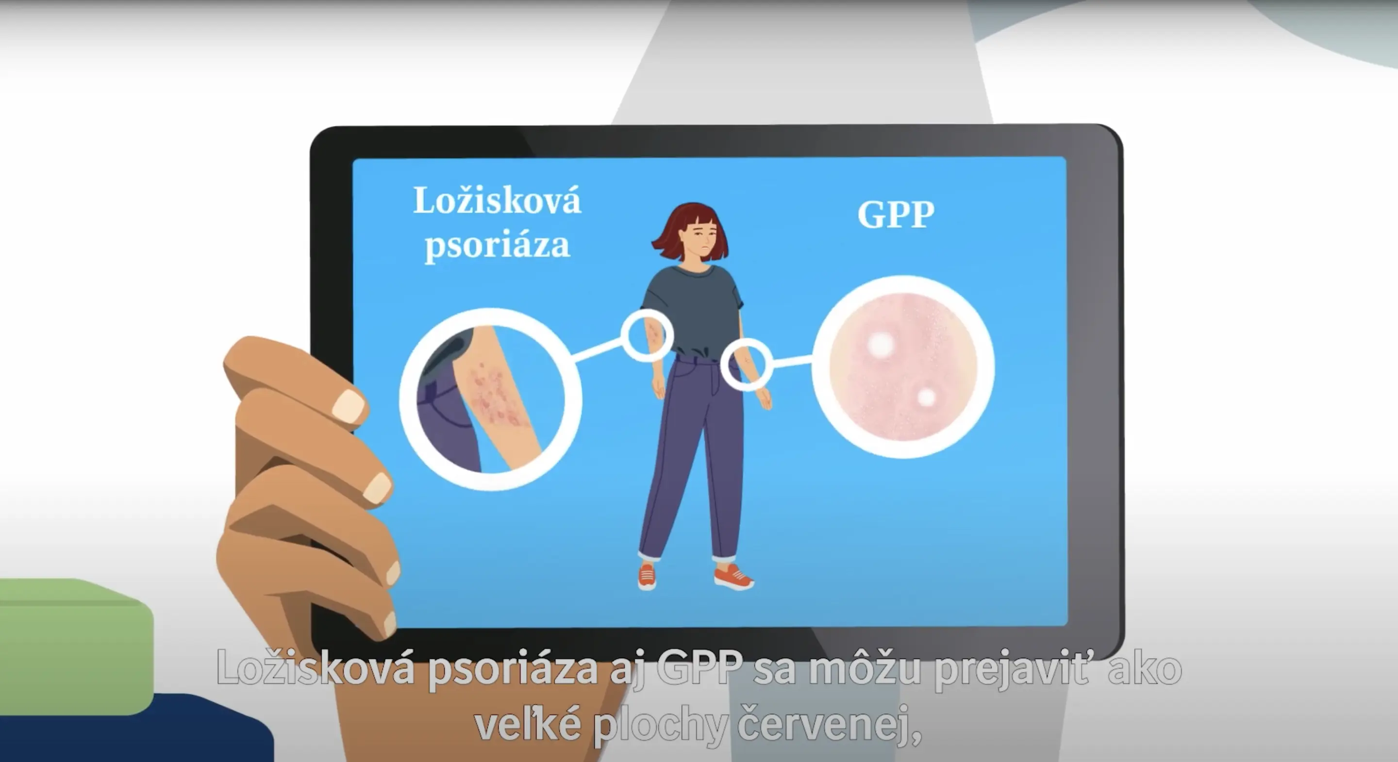 ložisková psoriáza